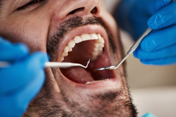Best Emergency Wisdom Tooth Extraction in Sherwood, WI